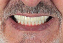 Full Mouth Implant Restoration