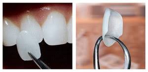 “Procedures done by prosthodontists, porcelain veneers"
