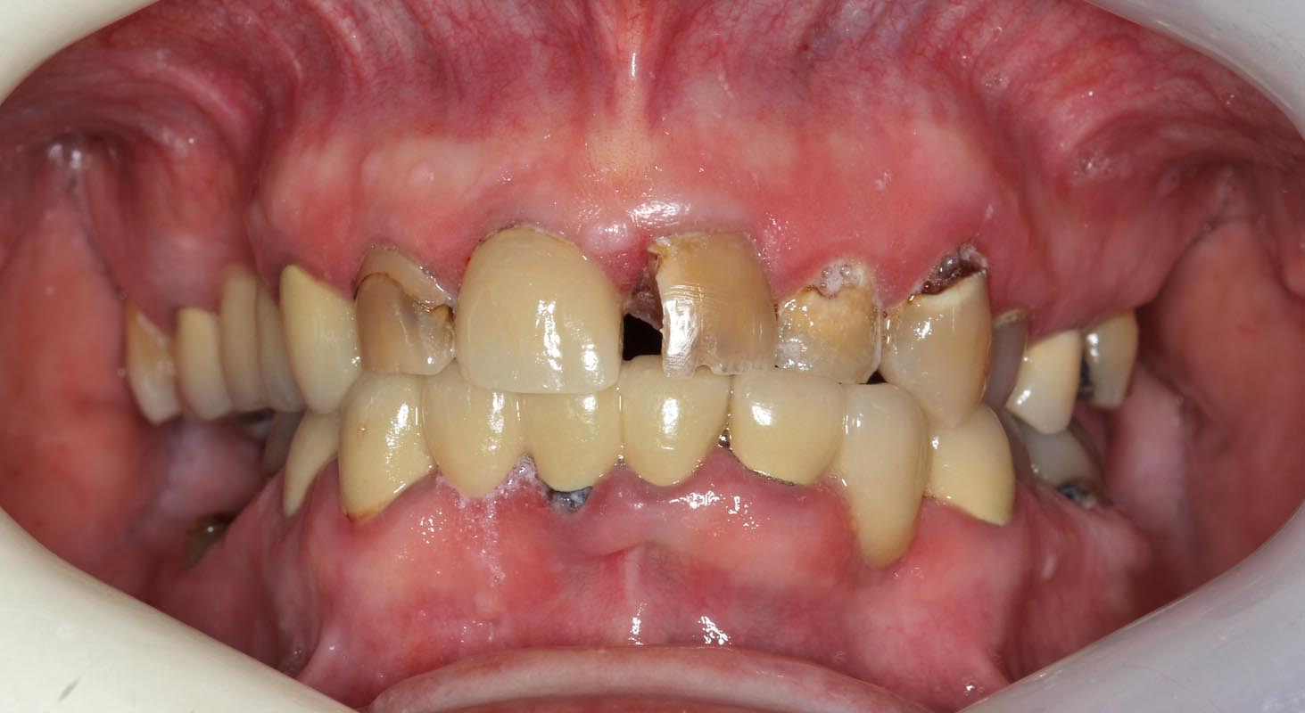 Full Arch/Full Mouth Implant Bridges Before