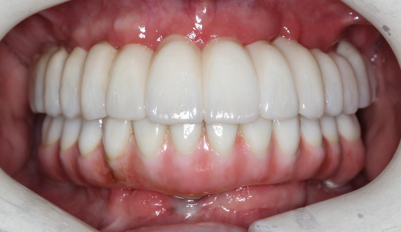 Full Arch/Full Mouth Implant Bridges After