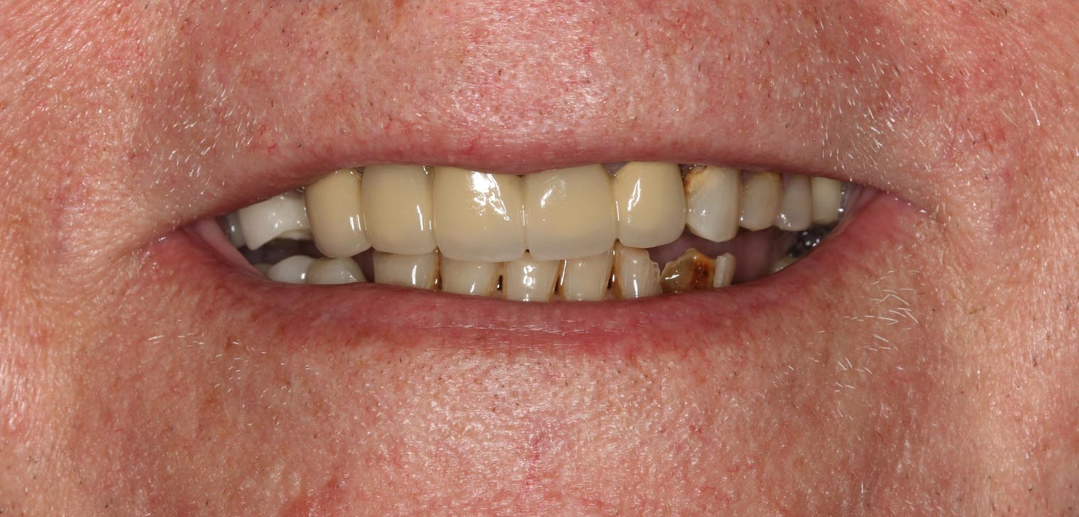 Full Arch/Full Mouth Implant Bridges Before