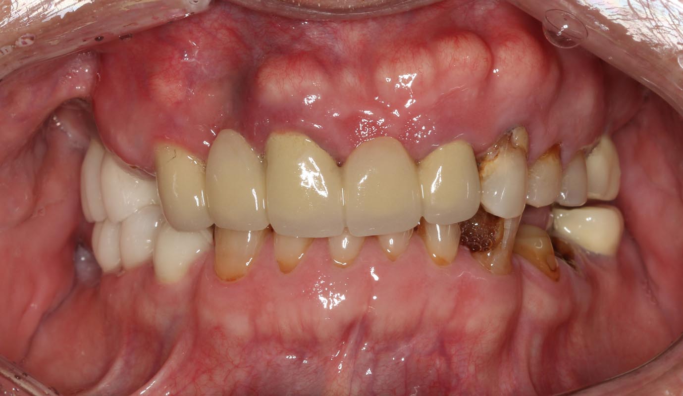 Full Arch/Full Mouth Implant Bridges Before