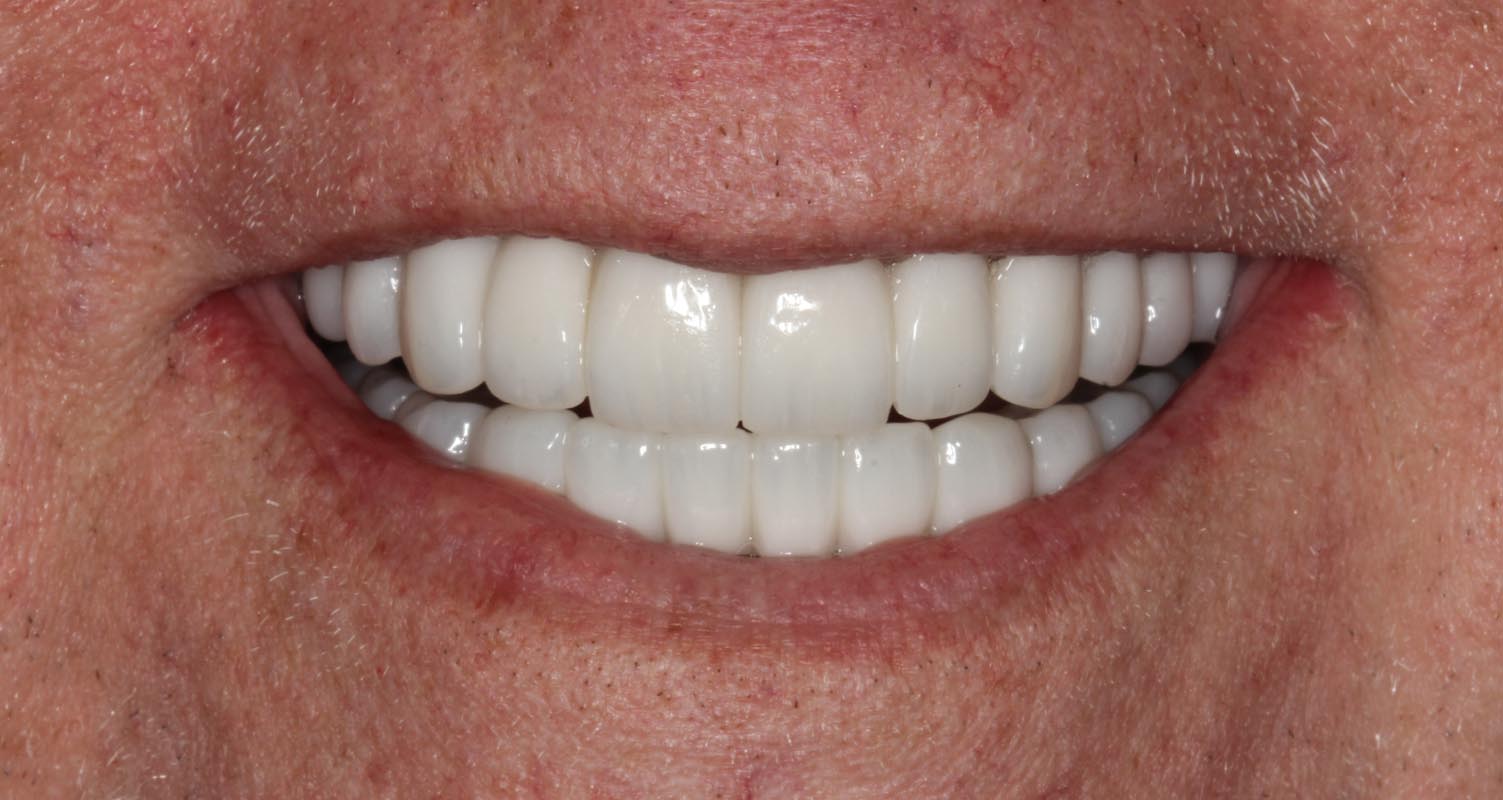 Full Arch/Full Mouth Implant Bridges After