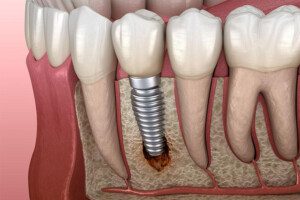 Who Is Responsible For Dental Implant Failure A cross-sectional illustration of a dental implant in the jaw, showing an inflamed area near the base of the implant.