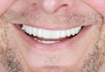 Full Mouth Implant Restoration after