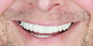 Full Mouth Implant Restoration after