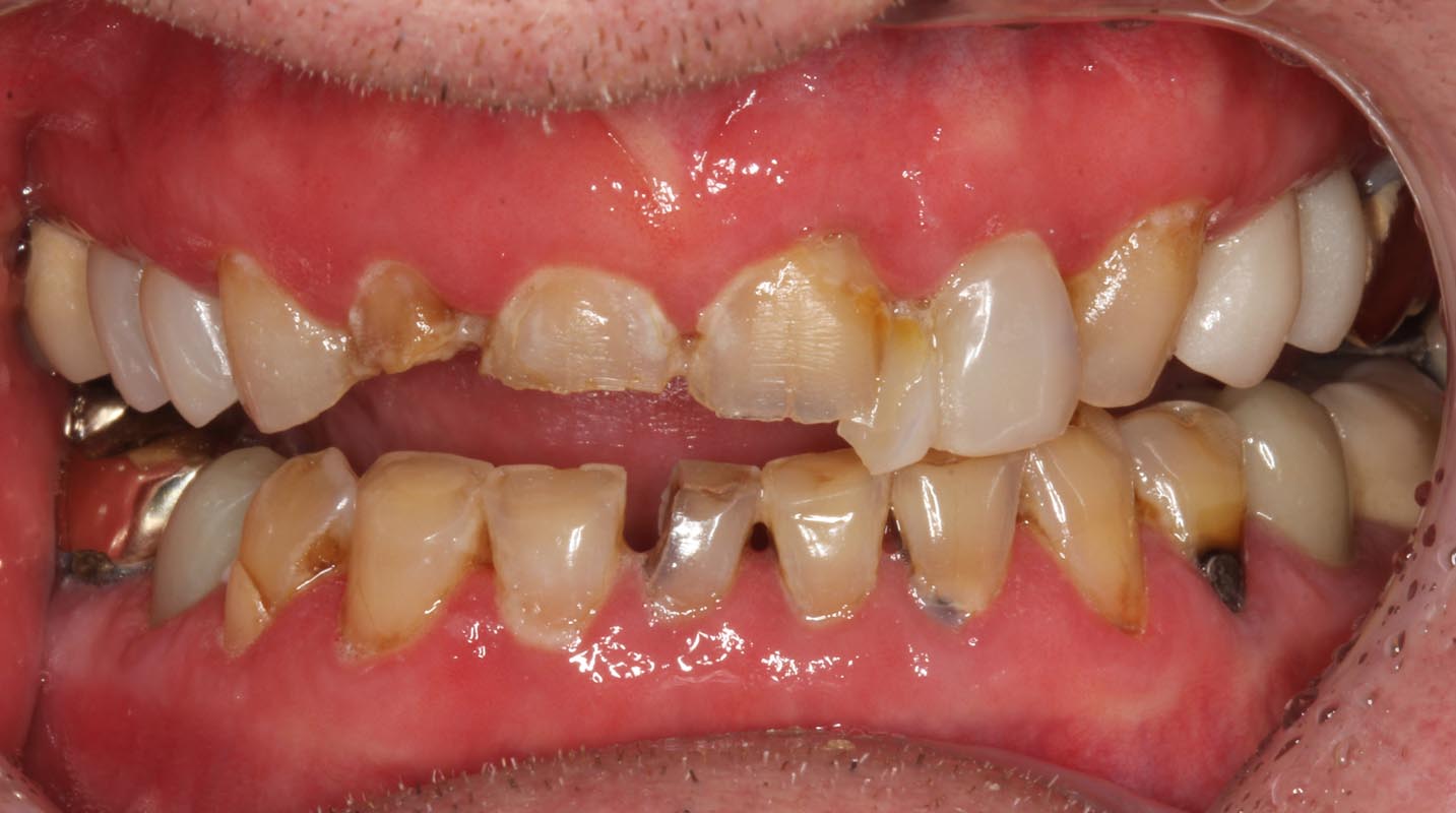 Full Arch/Full Mouth Implant Bridges Before