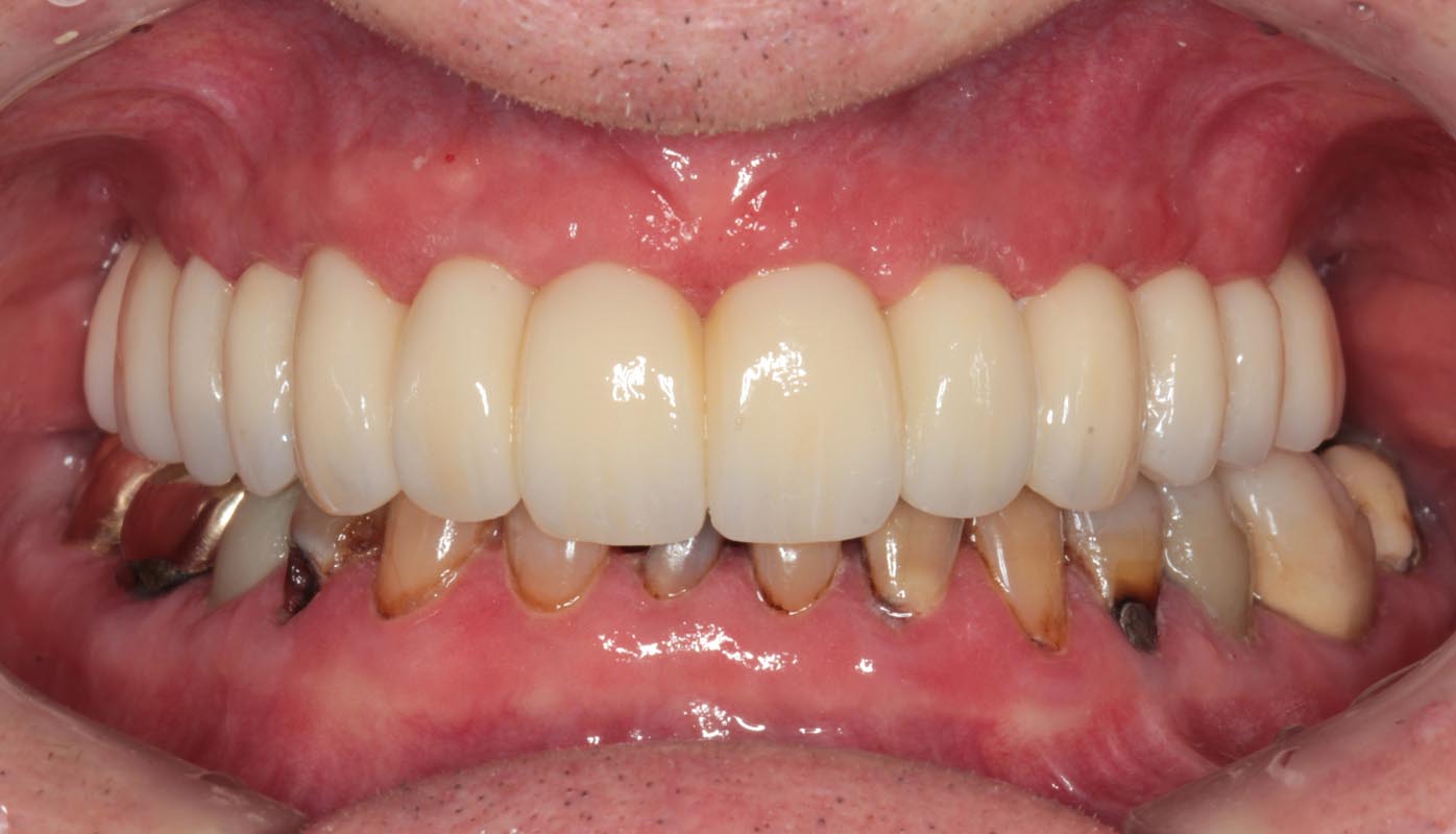 Full Arch/Full Mouth Implant Bridges After