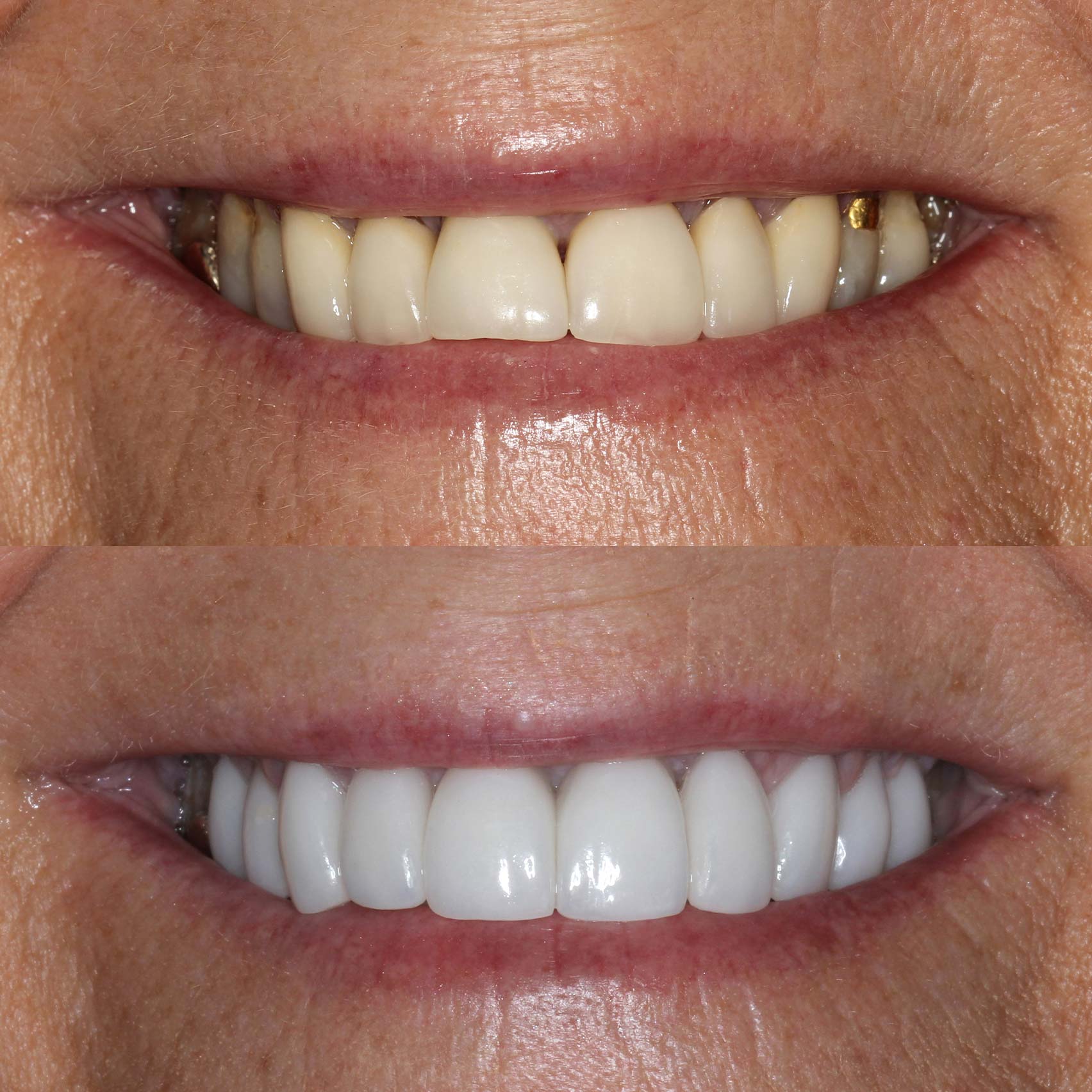 beforeafter before after