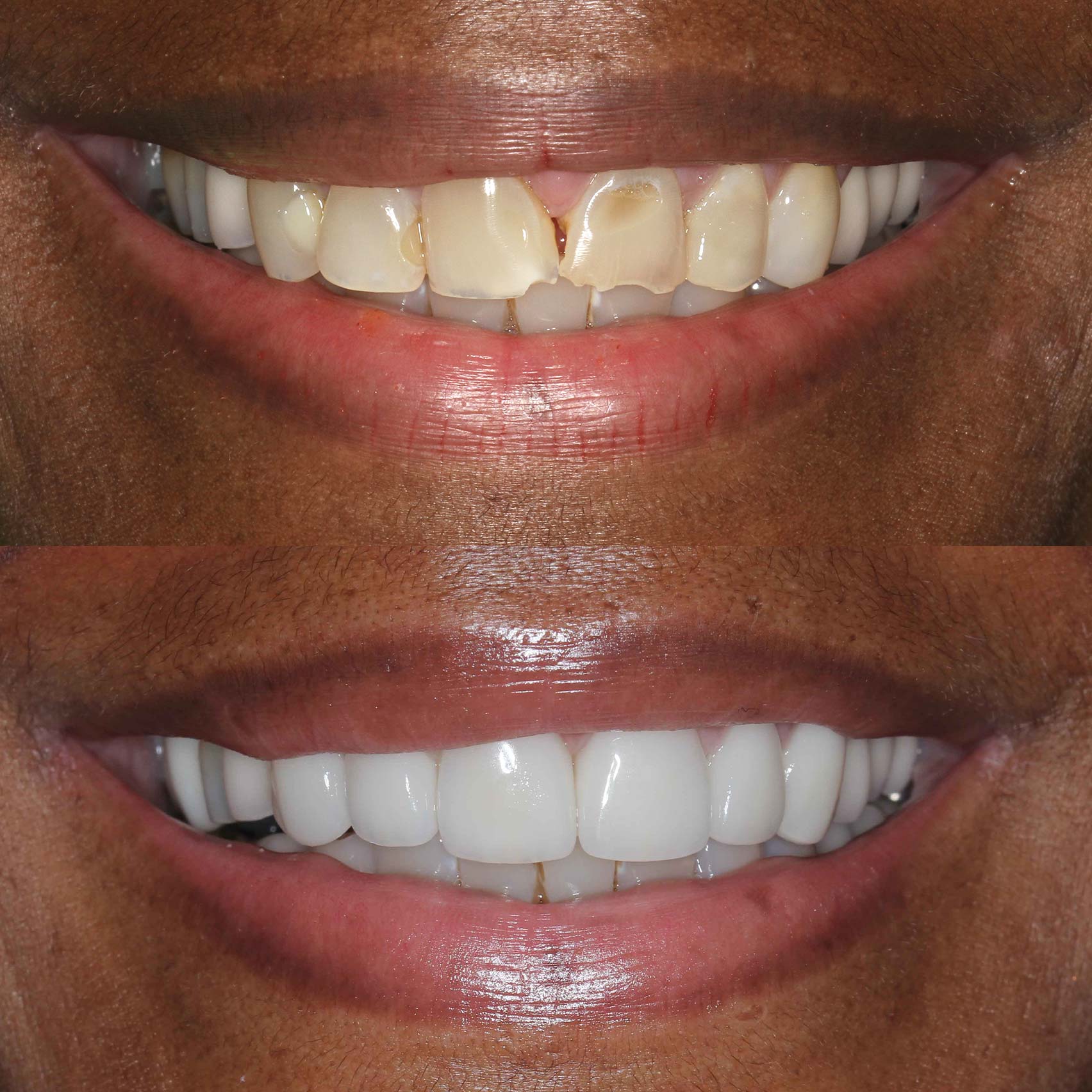 before after