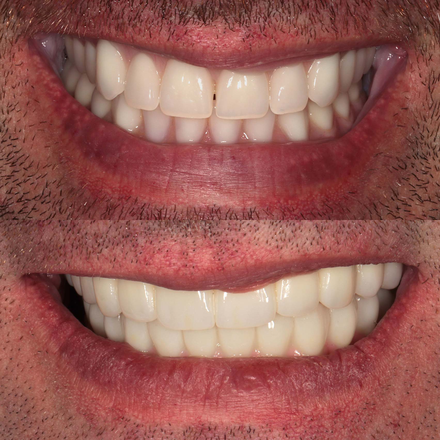 before after