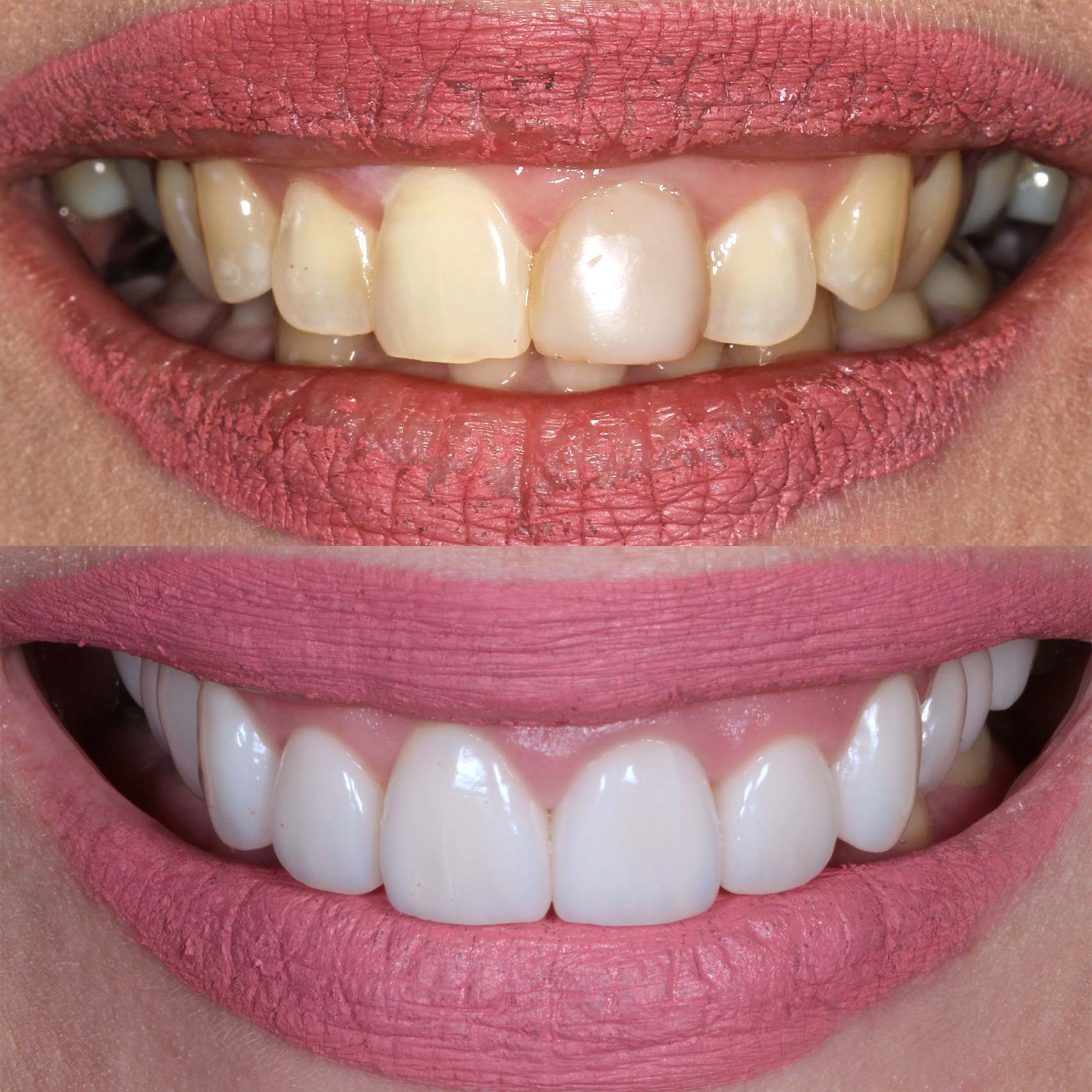 before after