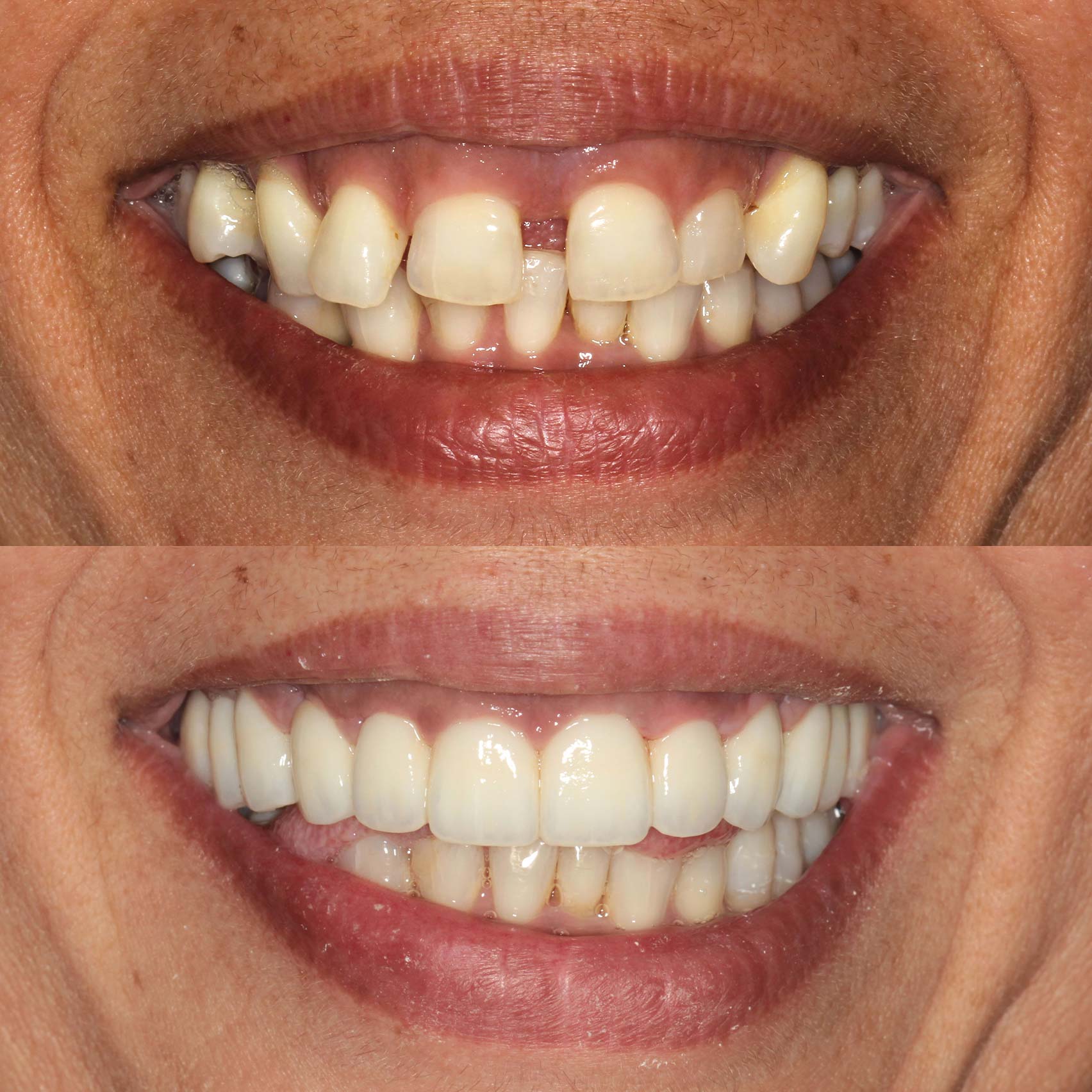 before after