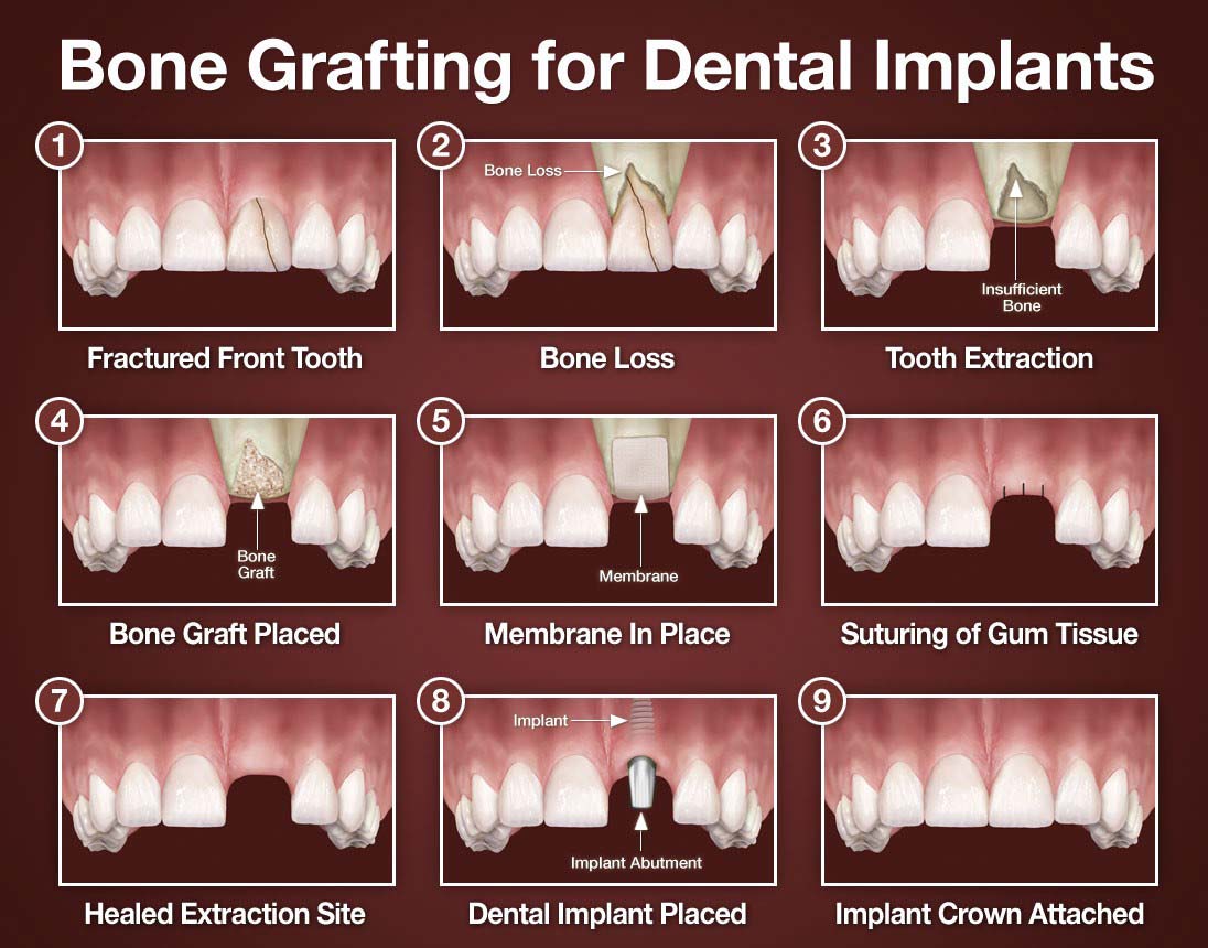 Learn More About Bone Grafting Dental Implant Center learn-more-about-bone-grafting-dental-implant-center