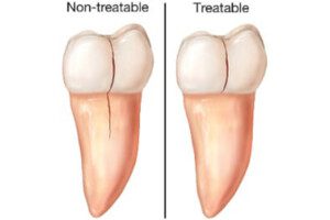 cracked-teeth