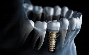 “Procedures done by prosthodontists, dental implants”