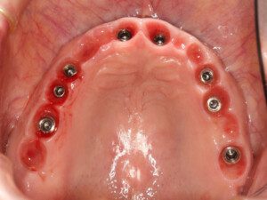 View of the upper palate before final implant bridge is screwed in.