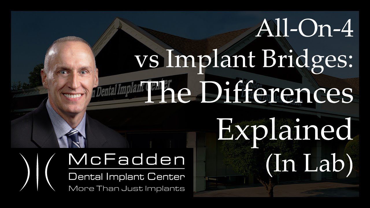 All-On-4 vs. Implant Bridges Explained In The Lab