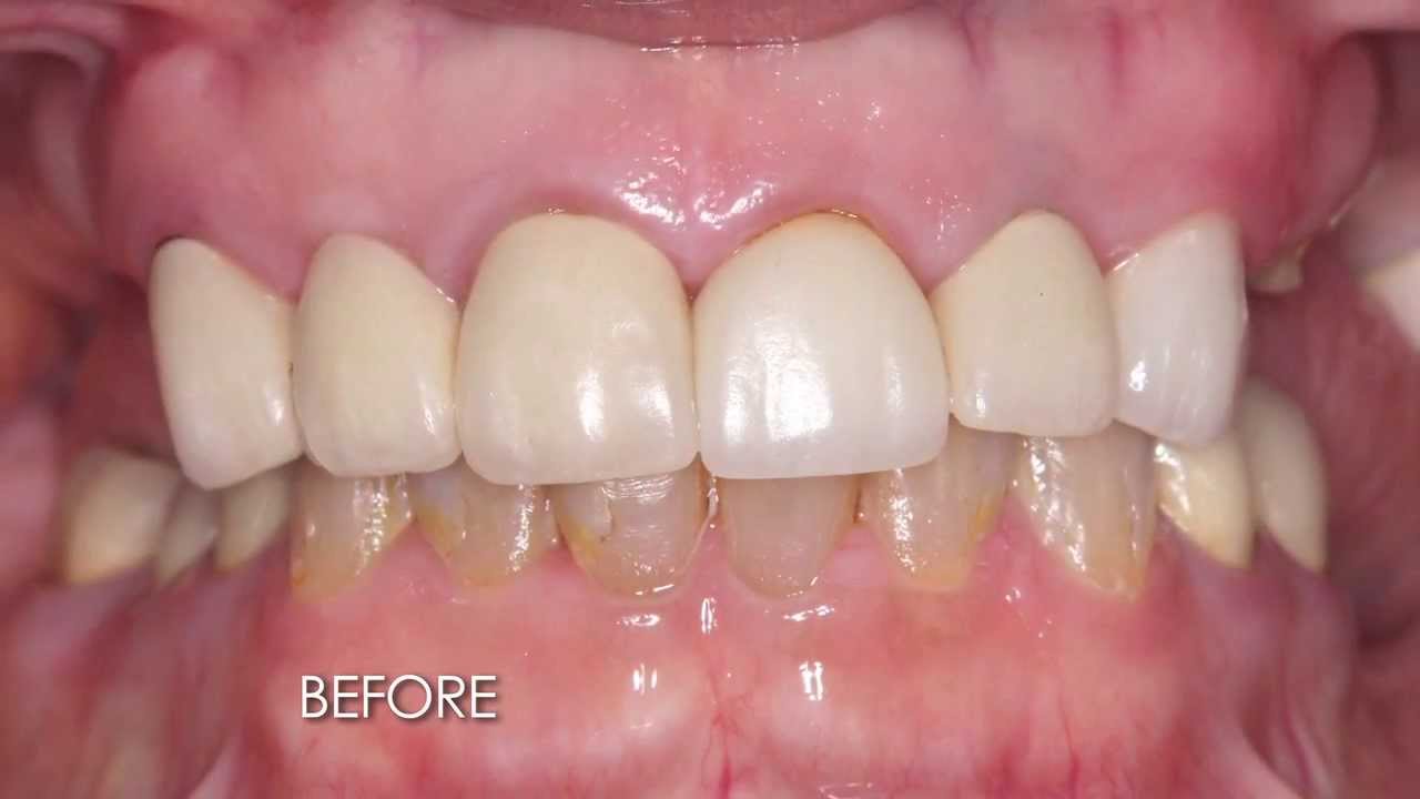 Dental Implant Reconstruction