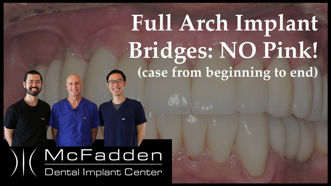 Full Mouth Implant Bridges No Pink, Start to Finish