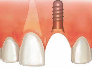"What to expect when getting dental implants, titanium implant placed in bone under the gums"