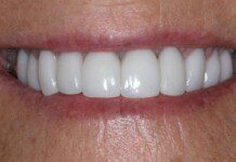 Cosmetic – Teeth + Implants, Crowns – Veneers – Central Incisor Implants – Female smile