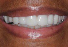 Veneers smile
