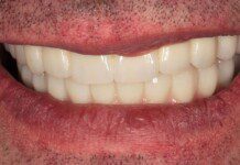 Full Mouth Implant Restoration smile