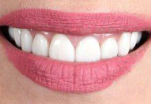 Veneers smile